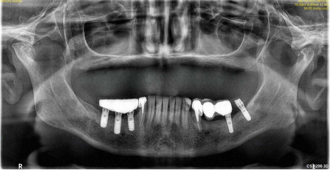X-Ray