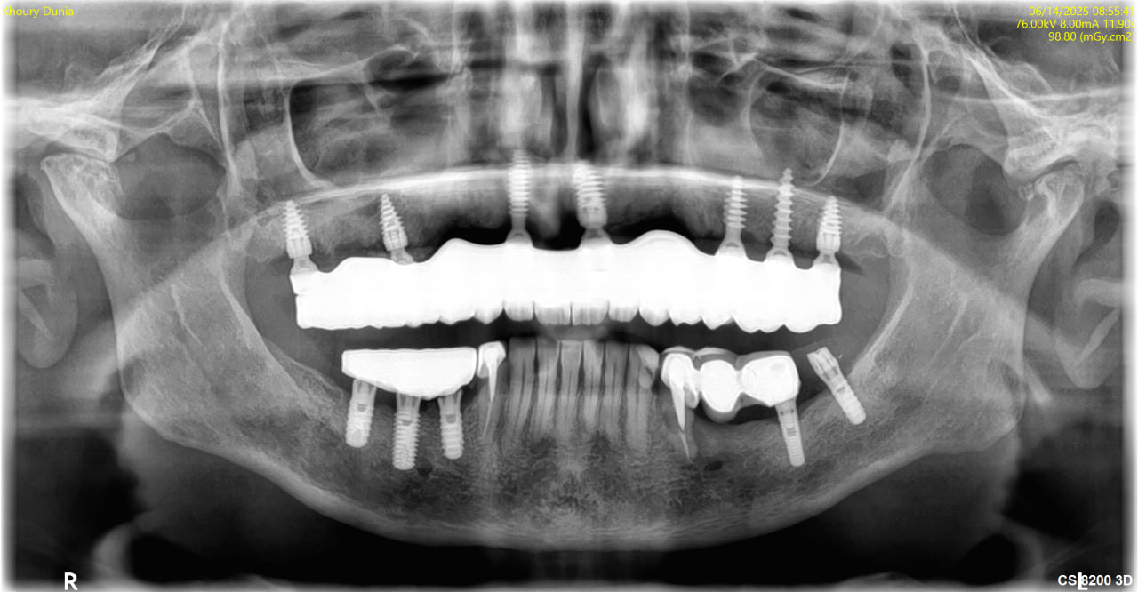 X-Ray – After