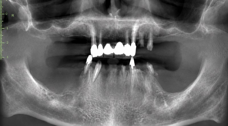 X-Ray