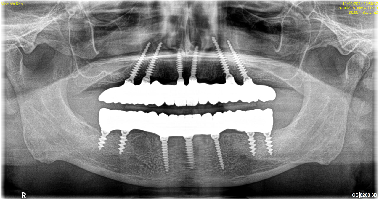 X-Ray – After
