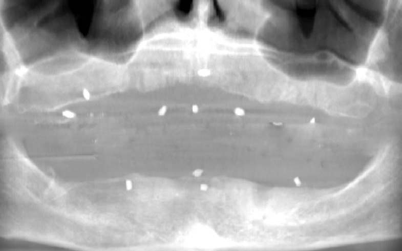 X-Ray