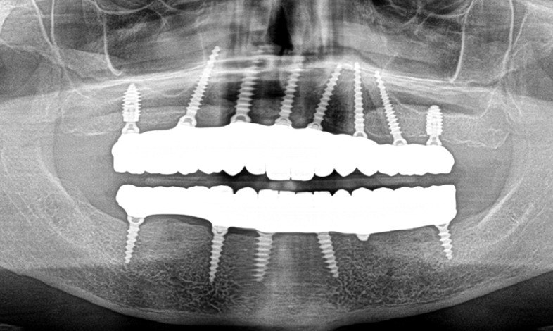 X-Ray – After