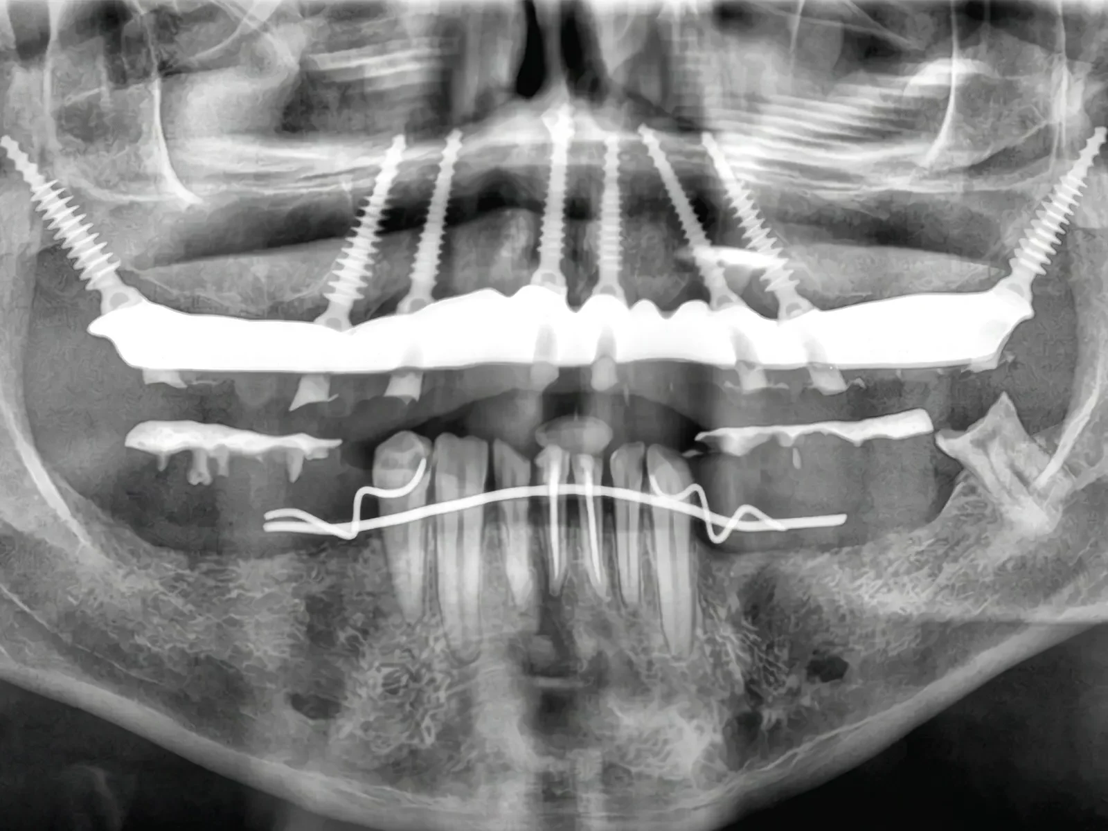 X-Ray – After