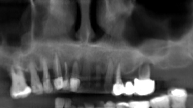 X-Ray