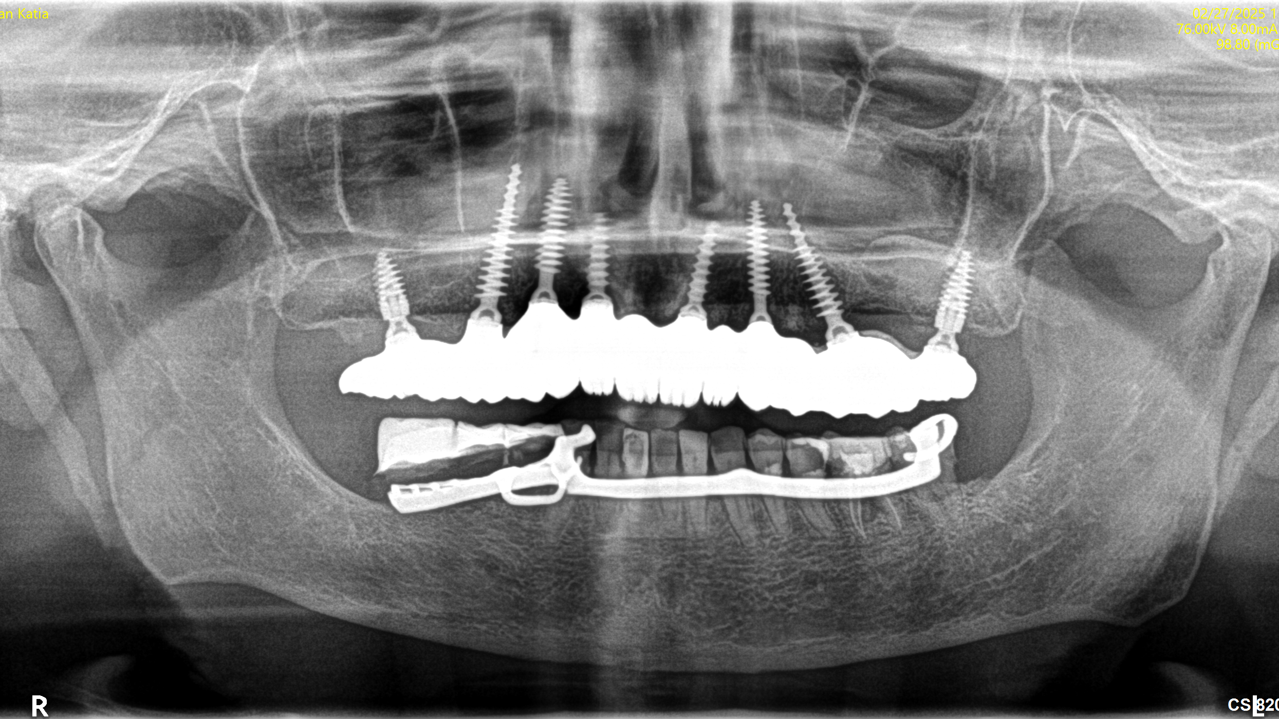 X-Ray – After