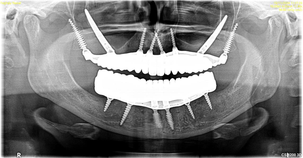 X-Ray – After